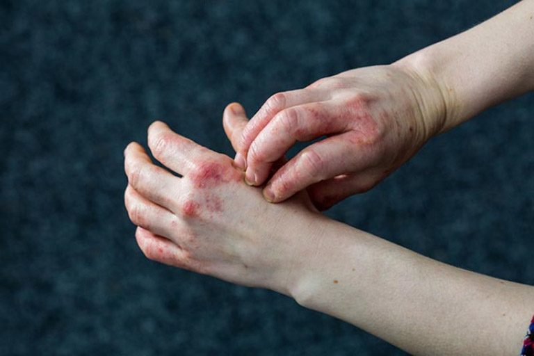 Bệnh vảy phấn hồng có thể dẫn đến biến chứng chàm hóa da